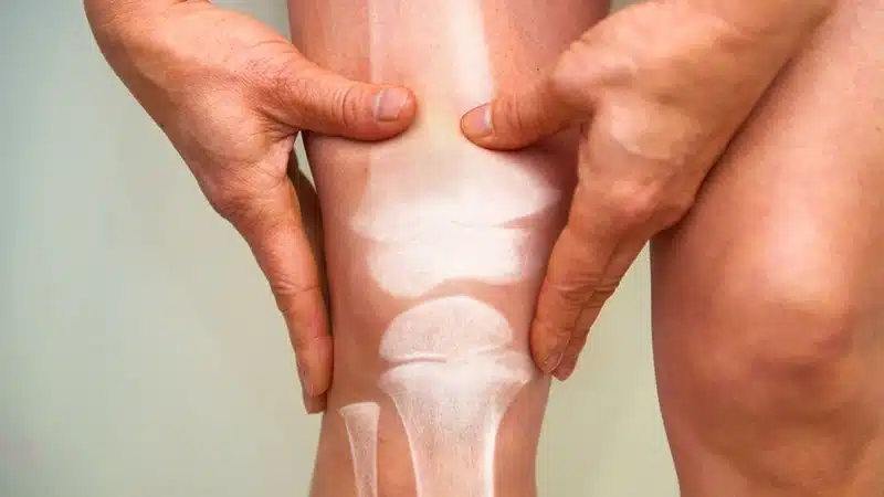 Prévenez et gérez l’arthrose : les meilleurs compléments pour les athlètes